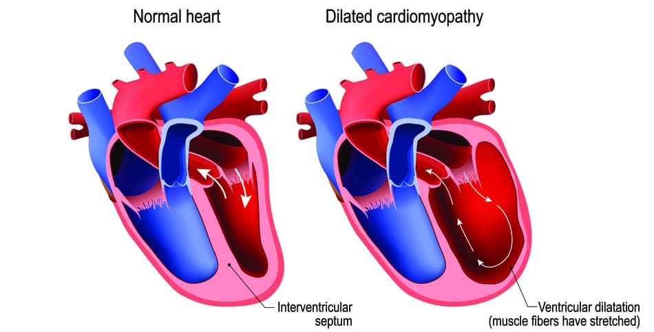 Een diagram van het hart van een hond dat aangetast is door DCM.